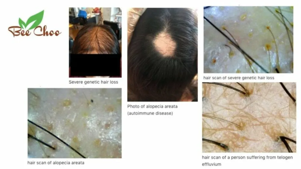 5 CAUSES OF HAIR LOSS AND WHERE TO FIND HAIR TREATMENT IN THAILAND