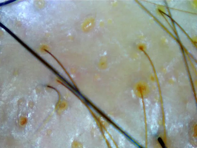 hair scan of severe genetic hair loss