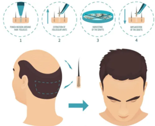How does FUE hair transplantation work