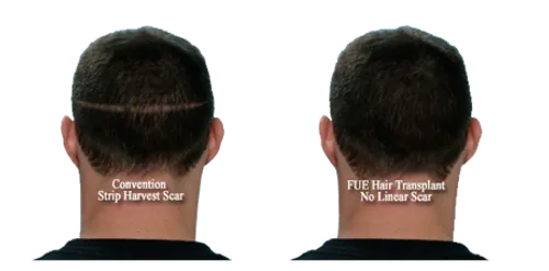FUE hair transplantation vs FUT hair transplantation