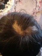 Karen's scalp progress photo, 22 November 2017