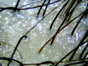 Example of clogged hair pore