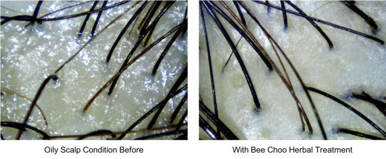 Herbal Treatment to get rid of oily scalp - Bee Choo Herbal