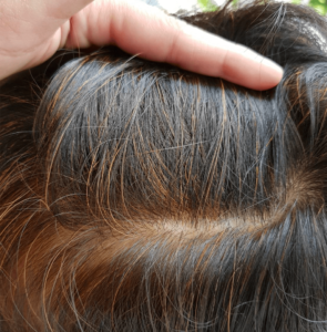 White Hairs Gone Immediately After Treatment