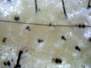 Broken off hairs caused by tinea capitis, photo taken by Bee Choo Origin