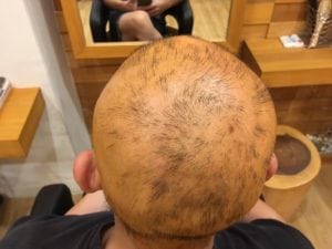 Hair loss due to chemical burns on scalp
