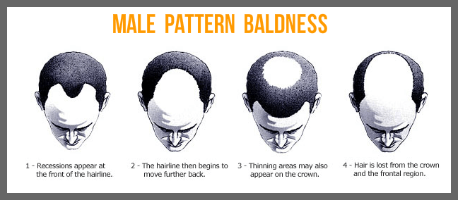 Male pattern baldness