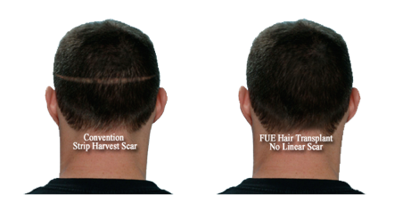 FUE hair transplantation vs FUT hair transplantation
