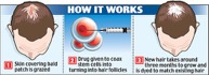 How does stem cell therapy work for hair loss?