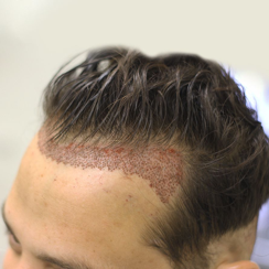 What is FUE Hair transplantation?