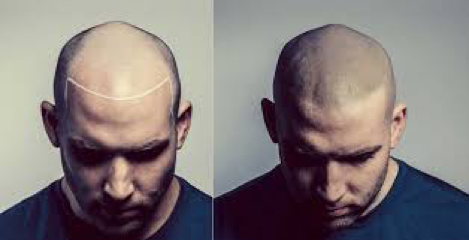 What is scalp micropigmentation?