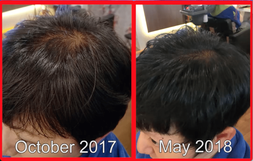Before after recovery from hair loss