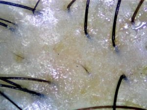 Example of hair loss caused by oily scalp Bee Choo Origin