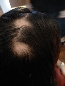 Hair loss from auto immune disease