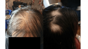 diffused hair loss vs patchy hair loss Bee Choo Origin