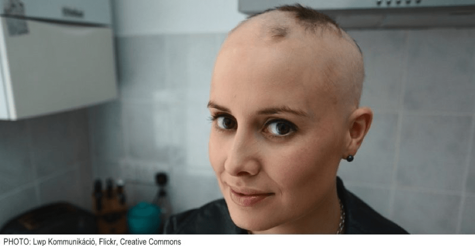 Living with alopecia bangkok thailand