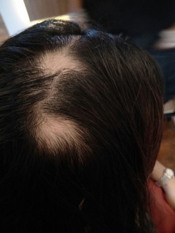 example of alopecia areata